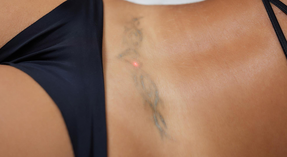 Αφαίρεση Τατουάζ | Σεφέρη - Δανιήλ Αναστασία | Πλαστικός Χειρουργός